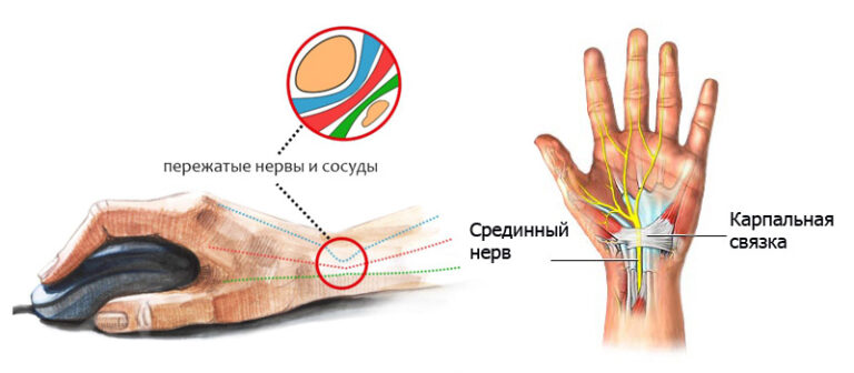 Синдром запястного клапана